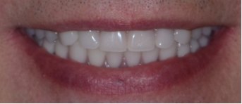 Closeup of man's smile after replacing missing bottom teeth