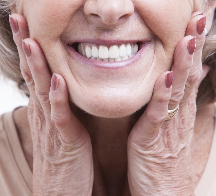 Closeup of smile after all on four dental implant denture placement