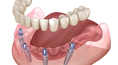 Illustration of implant dentures against white background