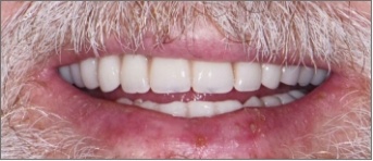 Closeup of complete smile with replaced teeth and flawless dental restorations