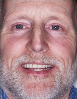 Older man smiling after tooth replacement and dental restoration