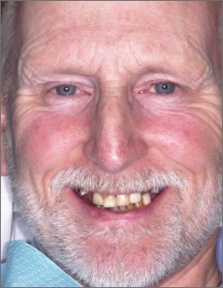 Older man smiling before tooth replacement and dental restoration