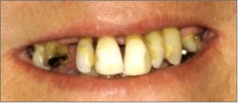 Closeup of man's smile before dental restoration and tooth replacement