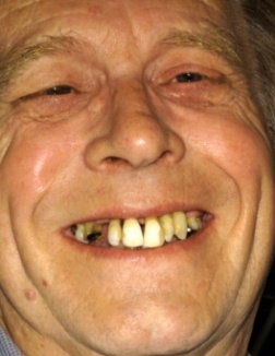 Man smiling before dental restoration and tooth replacement