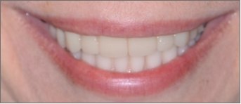 Closeup of woman's smile after tooth replacement and cosmetic dentistry