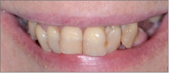 Closeup of woman's smile before tooth replacement and cosmetic dentistry