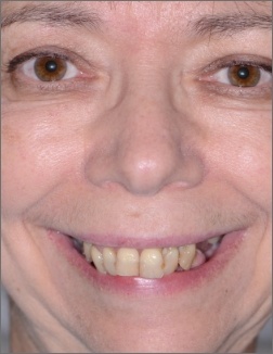 Woman smiling before tooth replacement and cosmetic dentistry