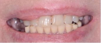 Closeup of smile with missing back teeth
