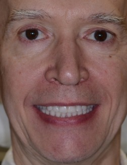 Man smiling after replacing missing bottom teeth