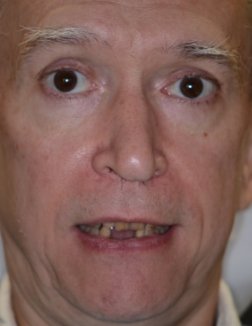 Man smiling with missing bottom teeth