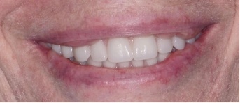 Closeup of flawless smile after replacing missing back teeth