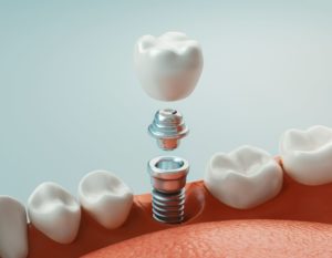 Illustration of dental implant rod inserted into the gums with a crown levitating above it